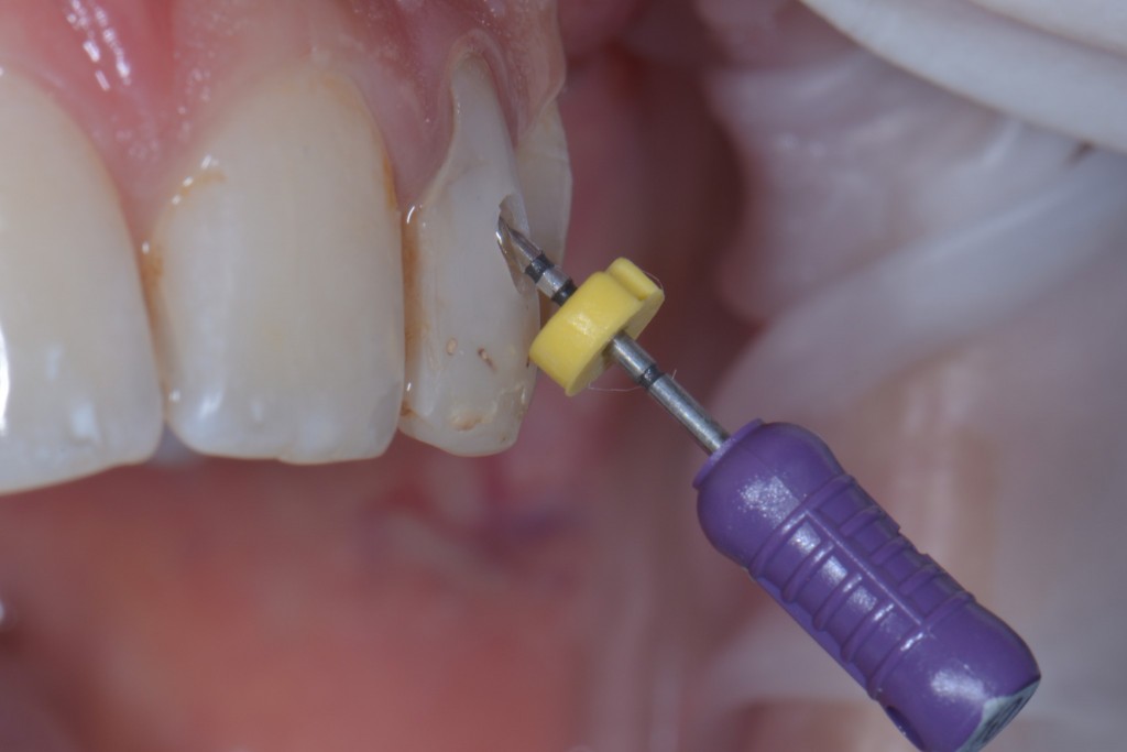 Dens in dente - Cavità di accesso vestibolare