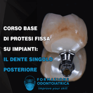 Corso Base di Protesi Fissa su Impianti: Il Dente Singolo Posteriore