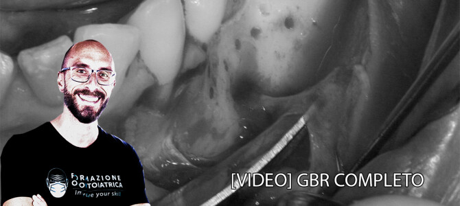 [Video] GBR in mandibola posteriore le fasi più importanti: gestione dei tessuti molli.