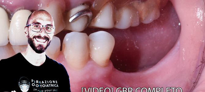 [VIDEO INTEGRALE] GBR verticale in mandibola posteriore: incisione e scollamento