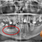Estrazione di un premolare distoverso incluso in mandibola