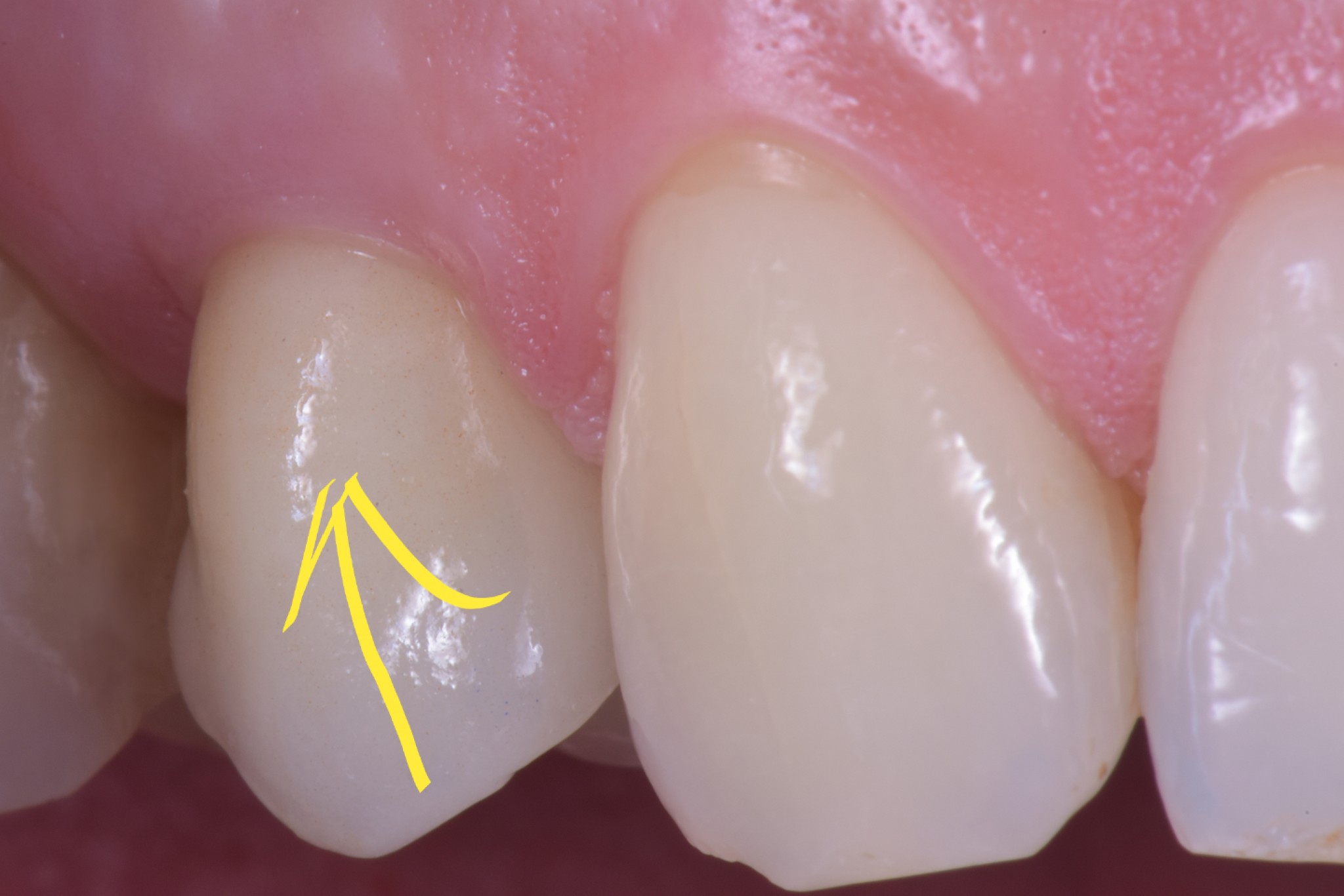 gestione dei tessuti molli - esempio premolare