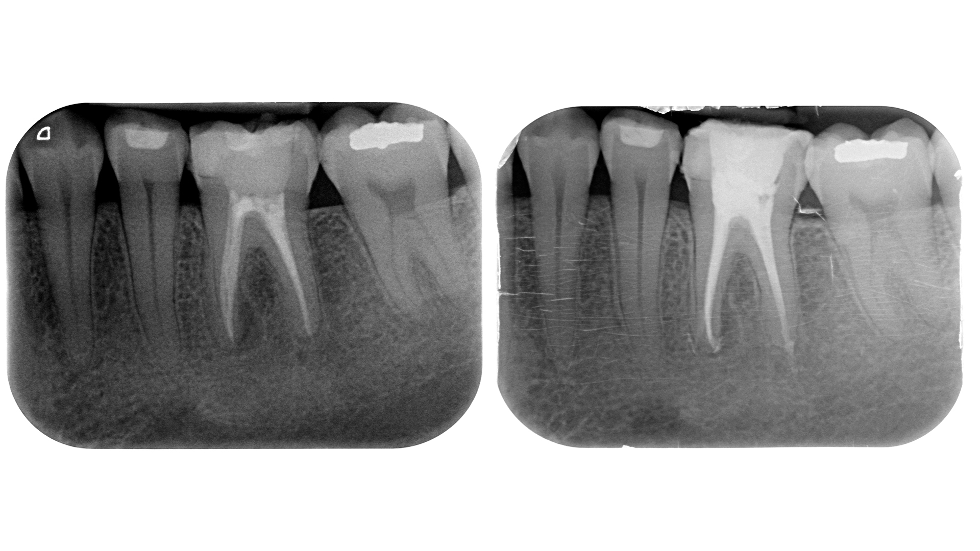 Canale Mesio-centrale - Radiografie 3.6 iniziale e finale