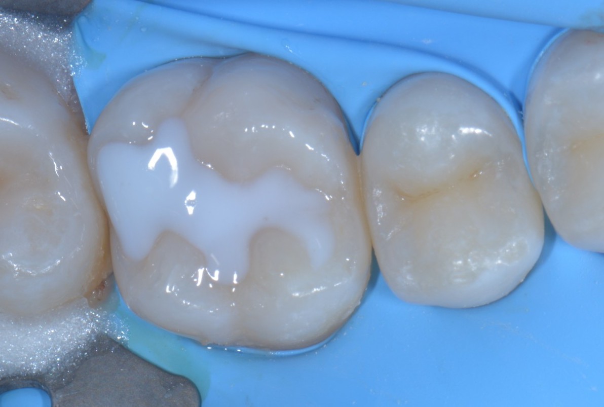 Teflon in odontoiatria - Stampaggio prime classi 2