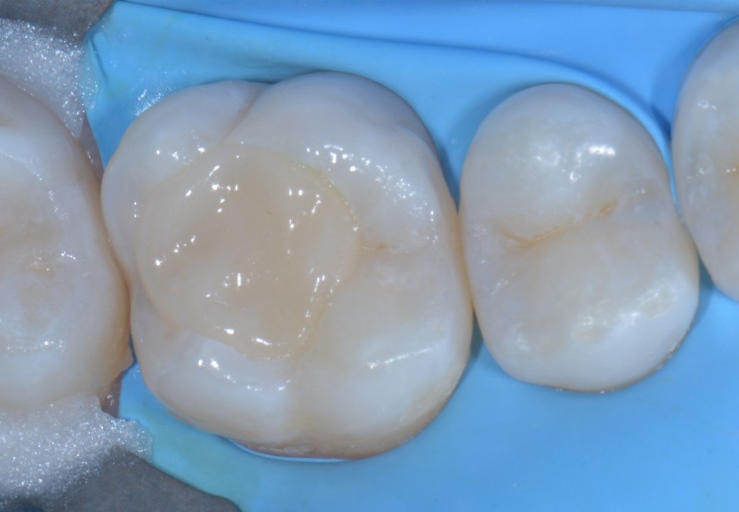 Teflon in odontoiatria - Stampaggio prime classi 6