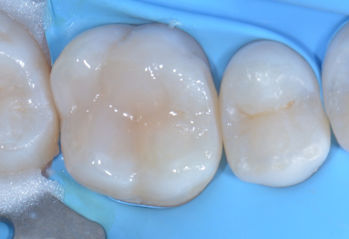 Teflon in odontoiatria - Stampaggio prime classi 8