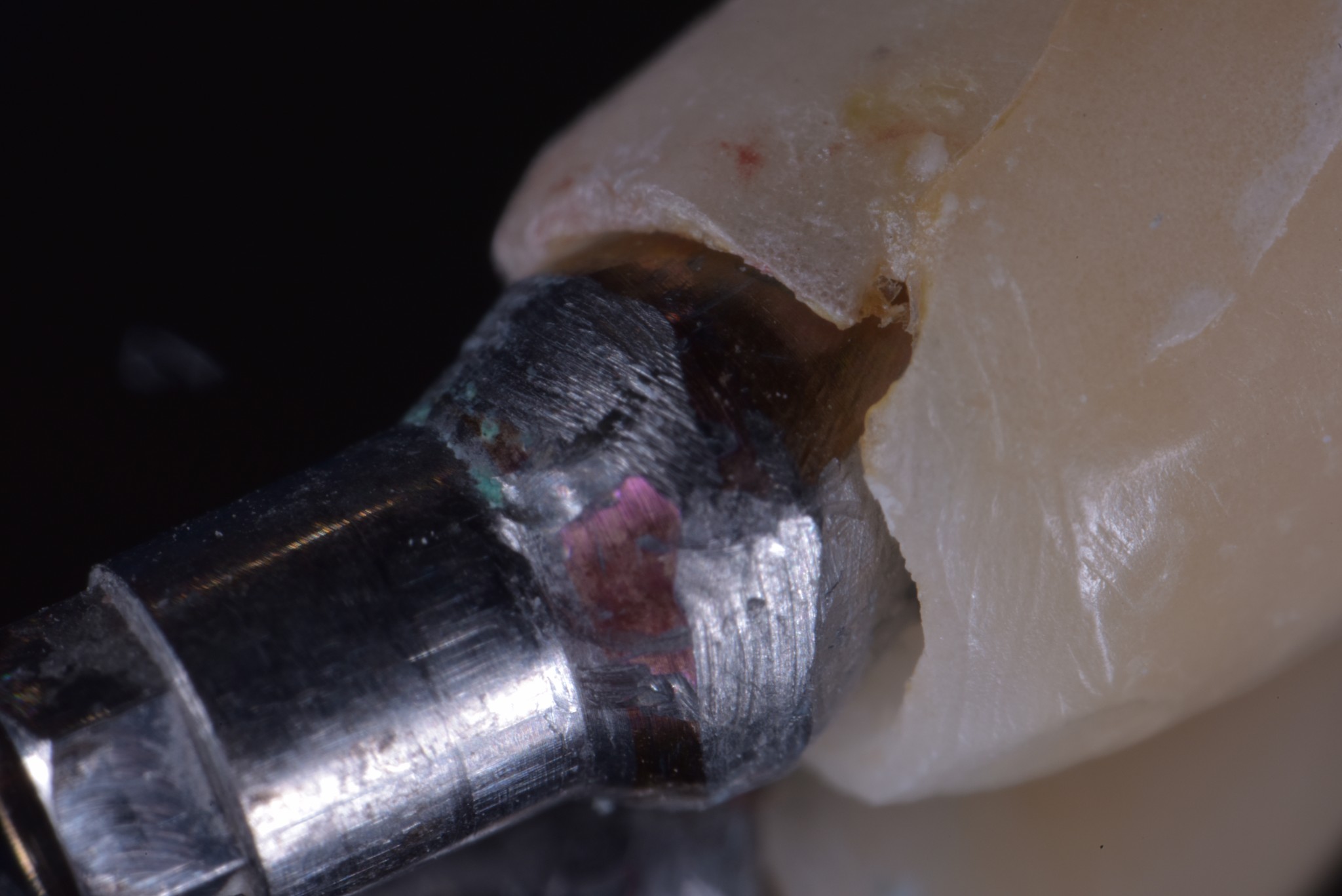 gestione dei tessuti molli - moncone ruvido 2