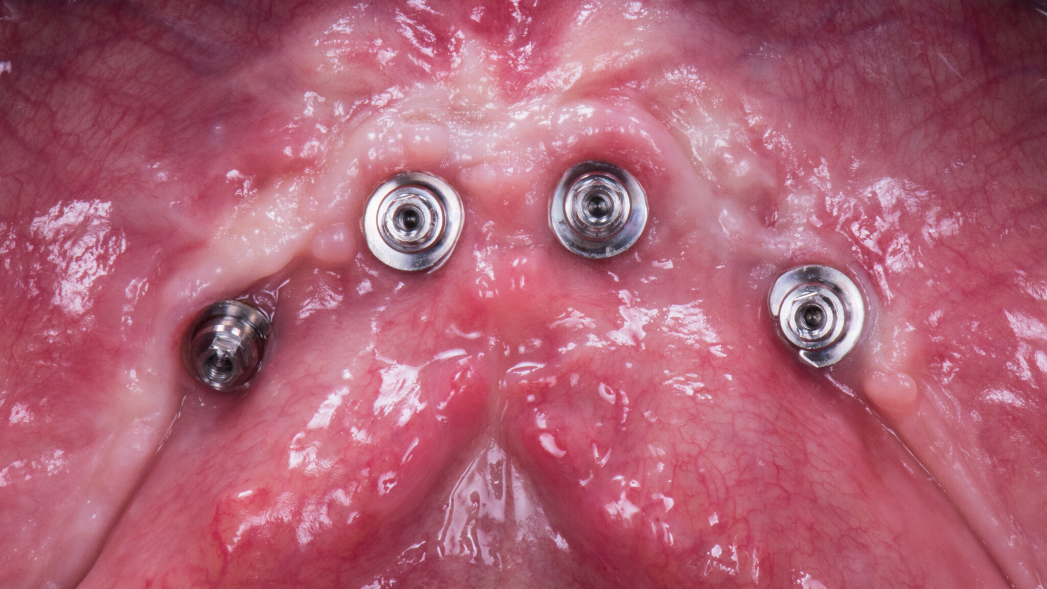 PS guarigione a 3 mesi