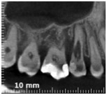 Riassorbimento esterno - Cone beam sagittale