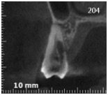 Riassorbimento esterno - Cone beam frontale