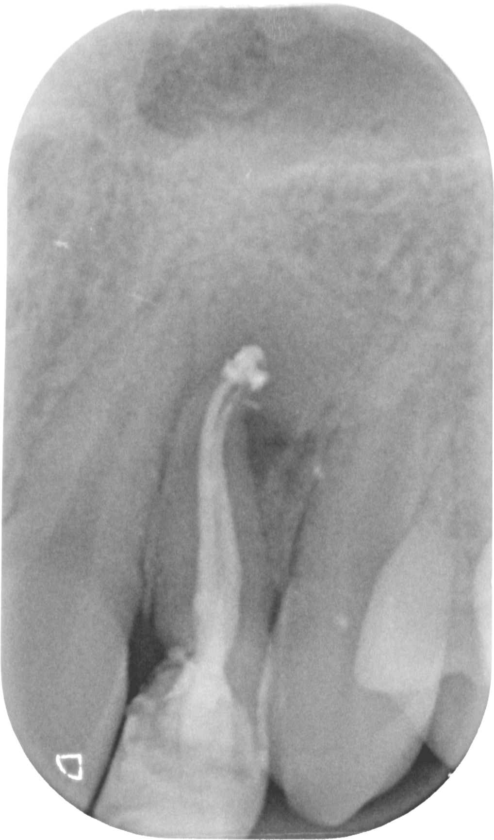Dens in dente - rx finale