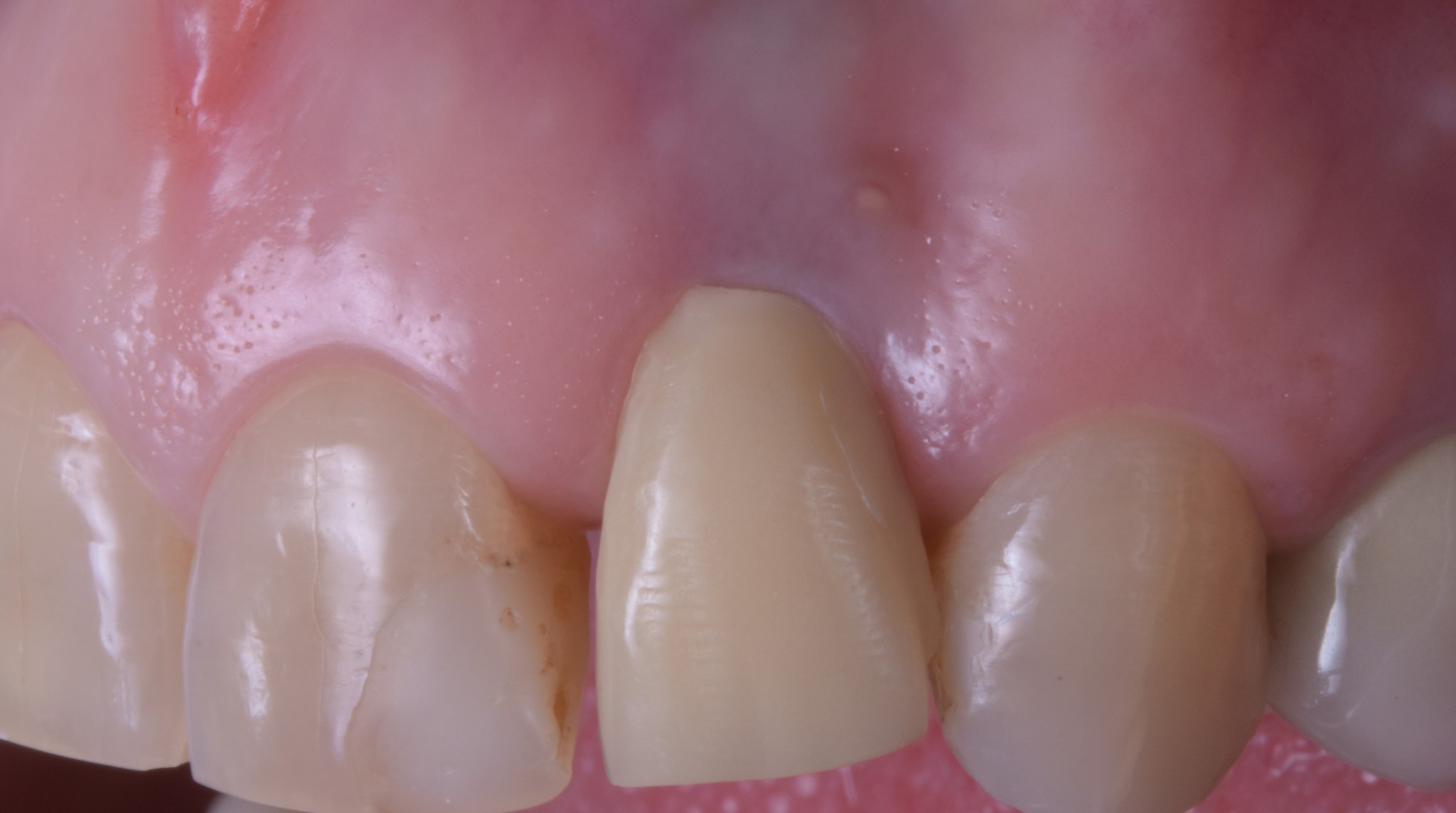 gestione dei tessuti molli - iniziale 2