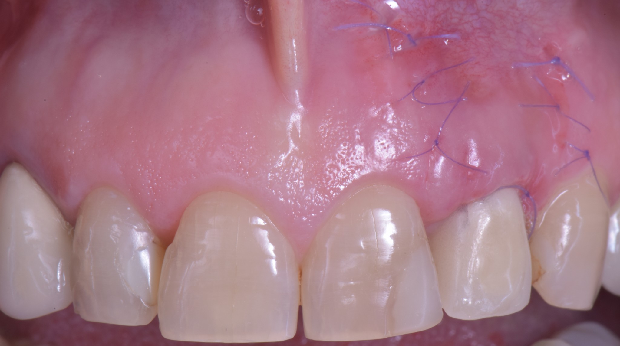 corso gestione tessuti molli - guarigione 1