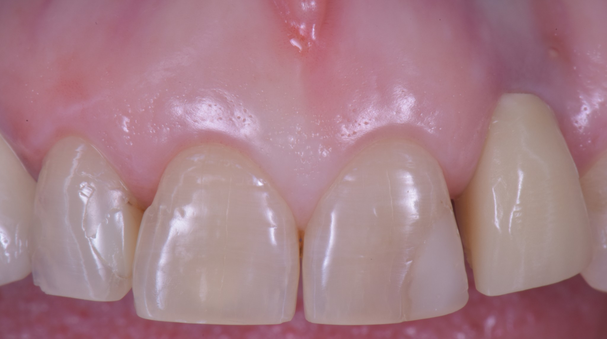 gestione dei tessuti molli - provvisorio Rosetta