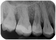 riassorbimento esterno - Radiografia iniziale