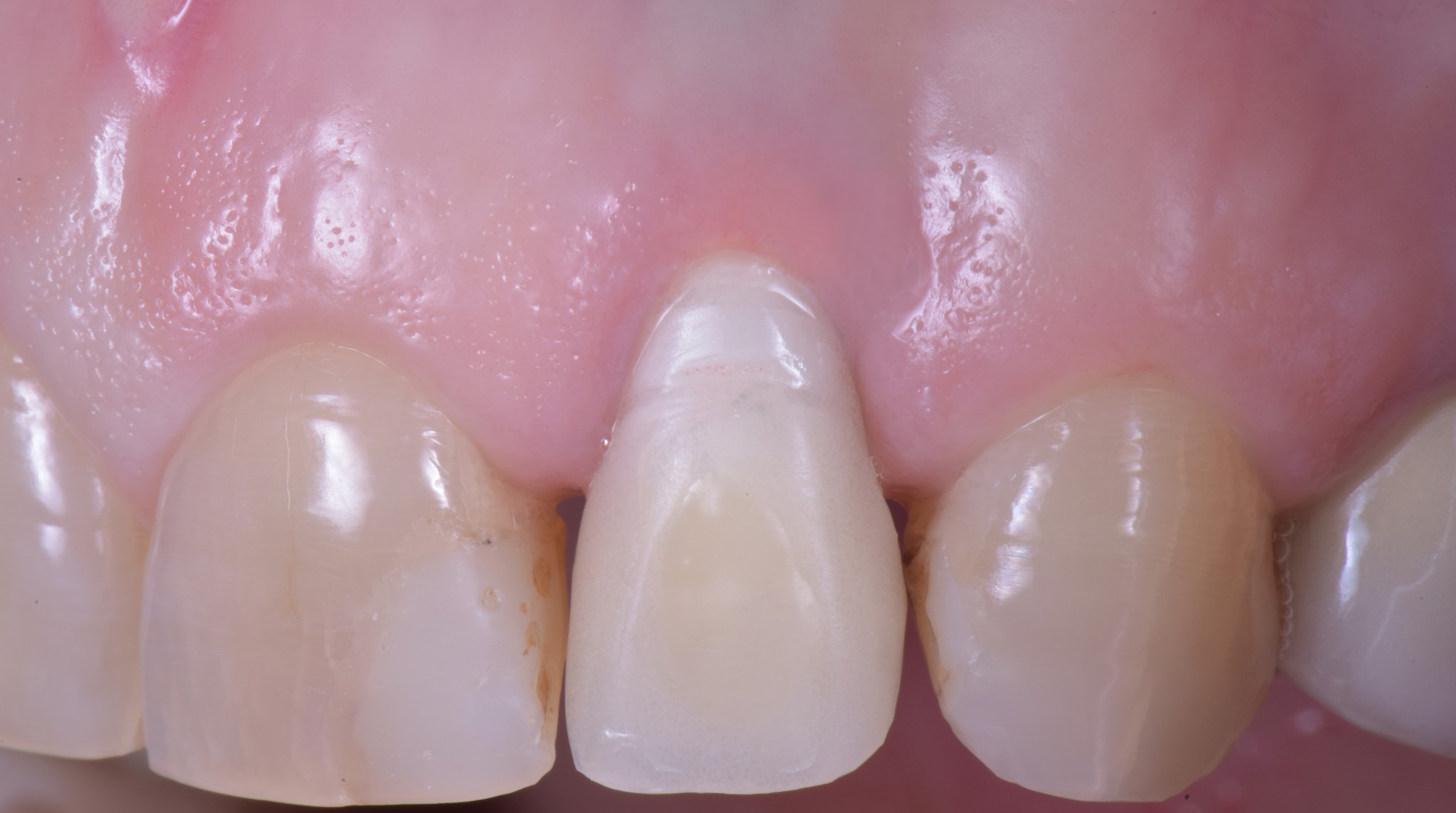 gestione dei tessuti molli - risoluzione della fistola