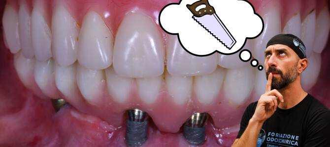 IL TUO PRINCIPALE FRENO IN CHIRURGIA IMPLANTARE: LE SEGHE MENTALI    (CON VIDEO CHIRURGICO TOP)